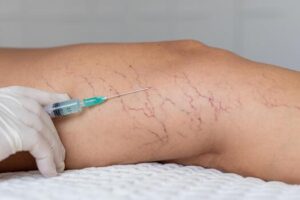 a close up of leg with visible varicose veins and capillaries a gloved hand holds a syringe preparing for a medical procedure photo