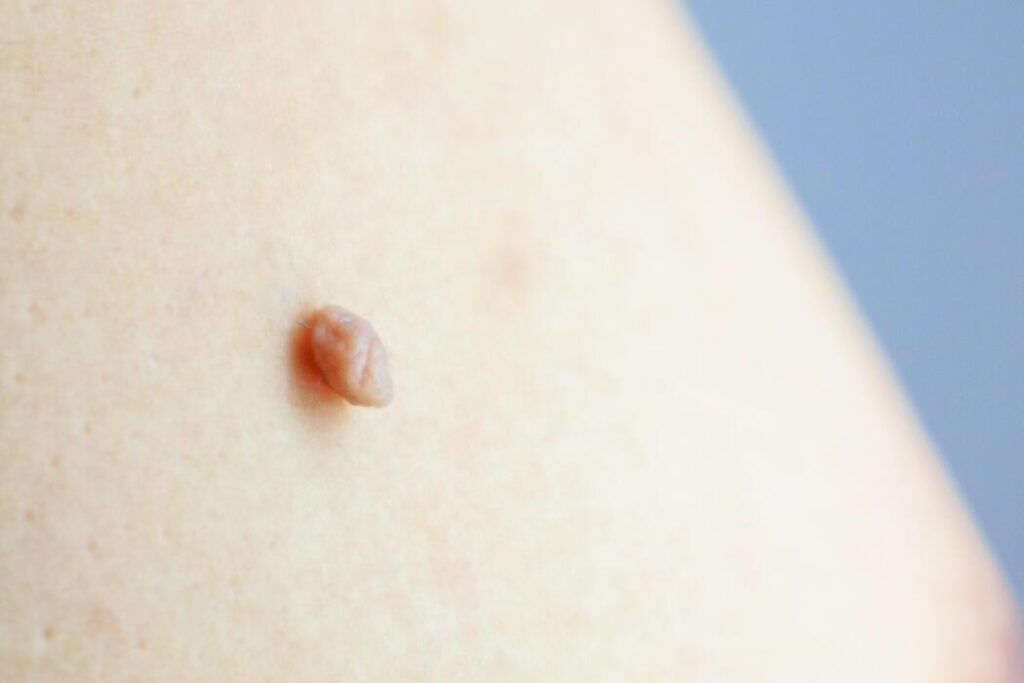 Skin Tags
