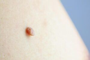 birthmark of papiloma neoplasm on human skin closeup photo