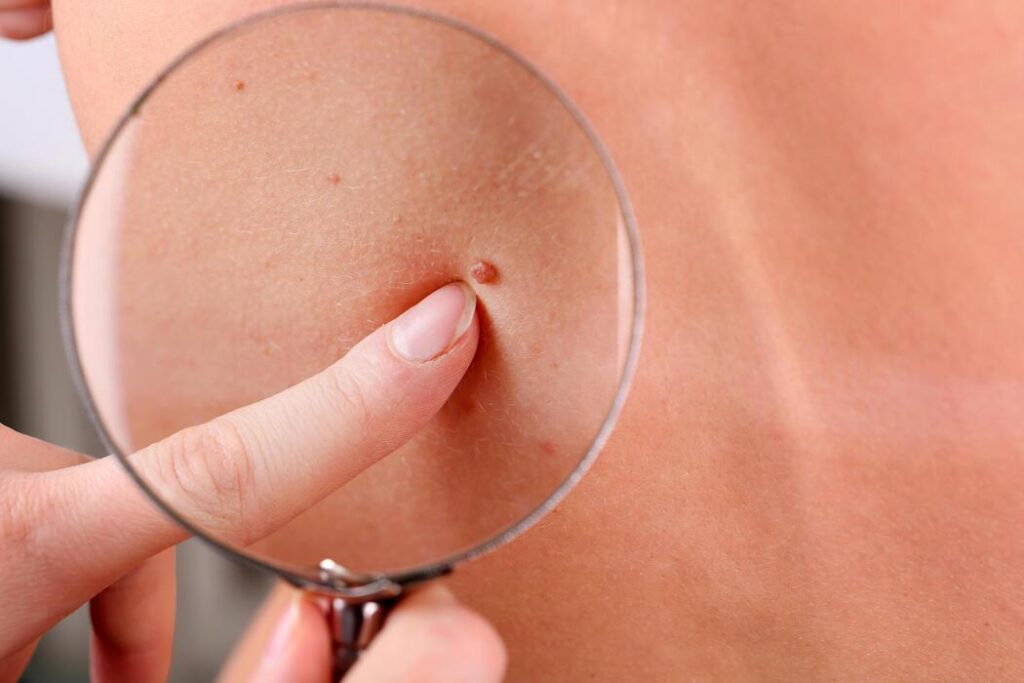 How Do You Know If a Mole Should Be Checked or Removed?